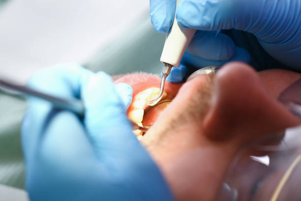 Best Dental Abscess Treatment in Rlsbad, CA